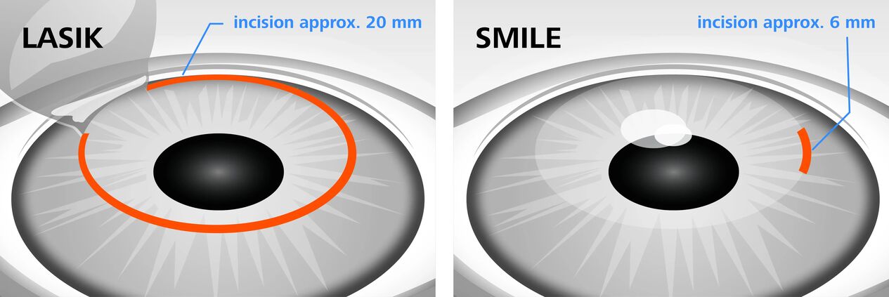 Comparison of laser vision correction methods LASIK and SMILE